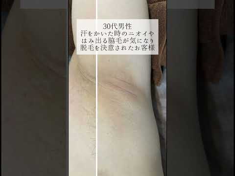 【30代 男性】脇脱毛ビフォーアフター #shorts