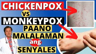 Chickenpox VS Monkeypox: Paano Malalaman sa Senyales - Payo ni Doc Willie Ong #1387