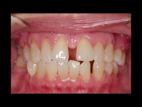 Invisalign Spacing: Nirenblatt Orthodontics