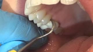 Scaling a Crown