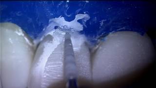 360° Veneer Matrix, Bioclear Matrix