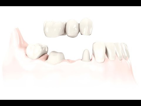 2 Teeth Supported 3 Unit Bridge
