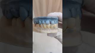 metal free crowns#zirconia #happypatients #smilecorrection