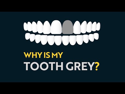 Why is My Tooth Grey?