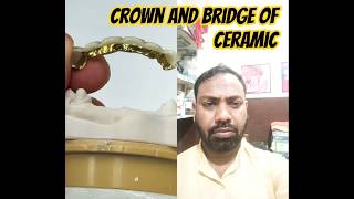 crown and bridge of ceramic ##dental #dentist #shorts #trending #smile #teeth #homeremedies #scaling