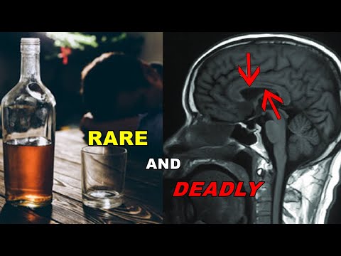 The DEADLY Alcohol-Induced Brain Disease You've NEVER Heard Of | Strange Medical Cases #2