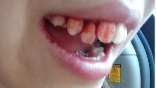 Tooth Emergency
