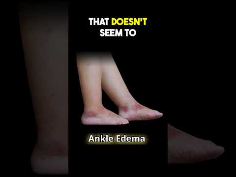 What Causes Ankle Edema/Swelling in The Elderly?