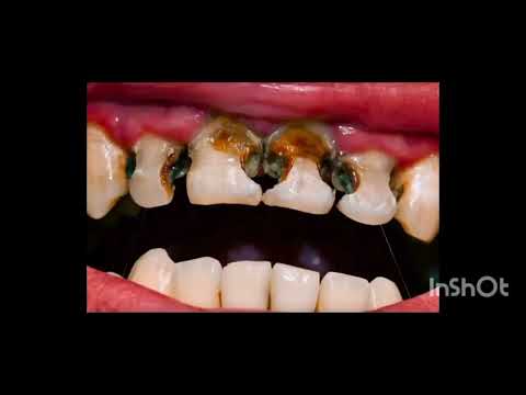 Dangers when you skip brushing your teeth