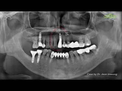 Crestal sinus lifting by blade osteotome techniques