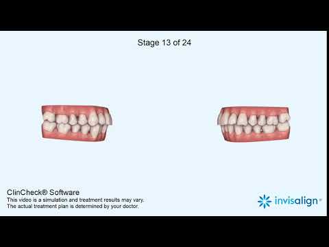 Tooth Movement with Invisalign