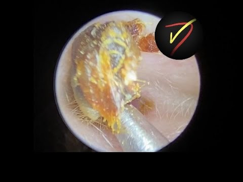 Ear Wax Removal - quick and easy