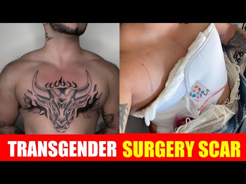 Transgender gets tattoo over surgery scars