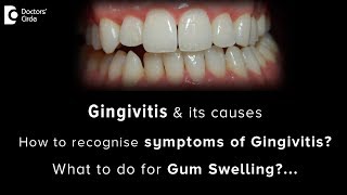 Gingivitis causes and symptoms | Gum swelling