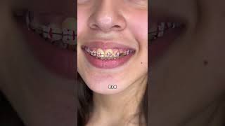 Braces Colors Before and after 8 weeks