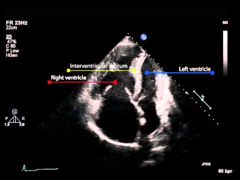 11B. Apical four chamber view - chamber size (pulmonary hypertension)