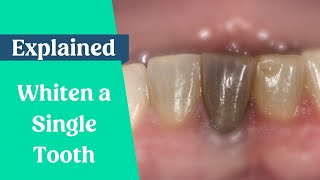 How to whiten a single dark tooth