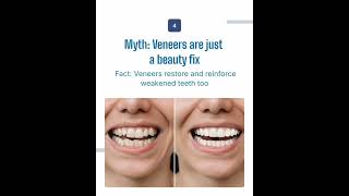 Do Veneers Weaken My Teeth? Myth vs Fact