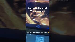 Benefits of NT scan and Causes Behind increased Nuchal Translucency
