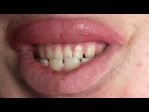 Australian Talking Mouth in: How To Smile