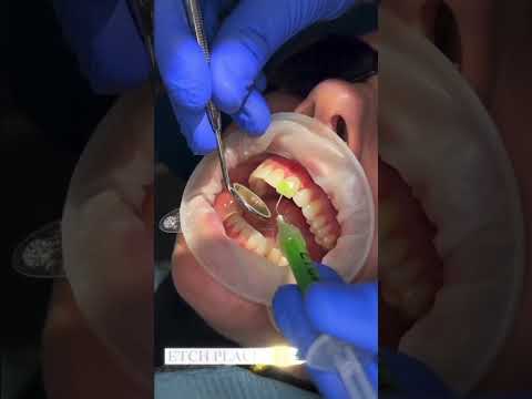 Composite bonding procedure #compositebonding #smilemakeover #dentalbonding