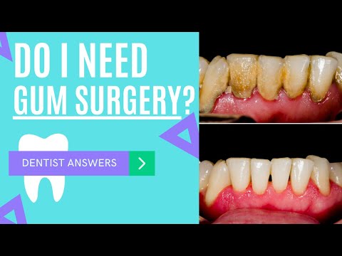 Osseous Surgery | Do I Need Gum Surgery? | Why I Need Gum Treatment l Pocket Reduction / Elimination