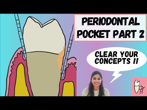 Periodontitis ‖ Periodontal Pocket ‖ Probing Pocket Depth V/S Clinical Attachment Level ‖ Perio Hub