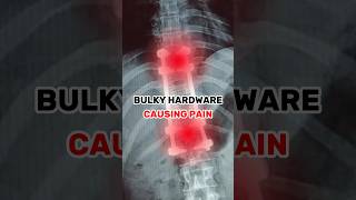 Spinal Fusion Hardware Removal Explained