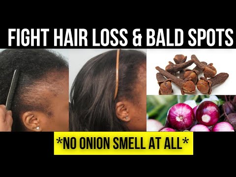 DIY CLOVES AND ONION FOR EXTREME HAIR GROWTH| NO SMELL #cloves for hair growth