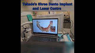 Digital Impression Through Intraoral Scanner Trios 3shape. #dentistry #smiledental #dentist