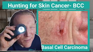 BCC: Basal Cell Carcinoma Skin Cancer: What You NEED to KNOW