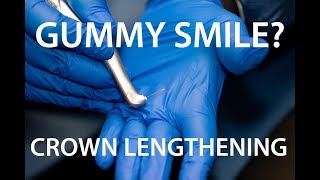 Dr. Gewant Discusses Crown Lengthening for Tooth Preservation