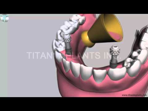 How to useTG Temporary abutment as fixed retrevible denture at the chair side
