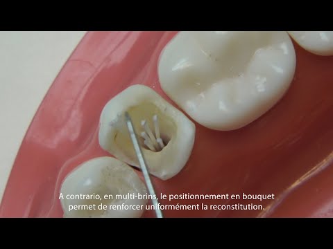 Procédure du système multi-tenons Biolight Drill-Free