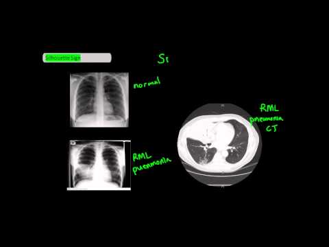 Silhouette Sign on Chest X-Ray [UndergroundMed]