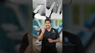 பதியம் செய்த பல்லை கழட்ட முடியுமா? - Can we remove the dental implants |Dr.Karthikeyan | Denta Kings