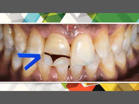 A broken tooth has been restored with E-max crown.