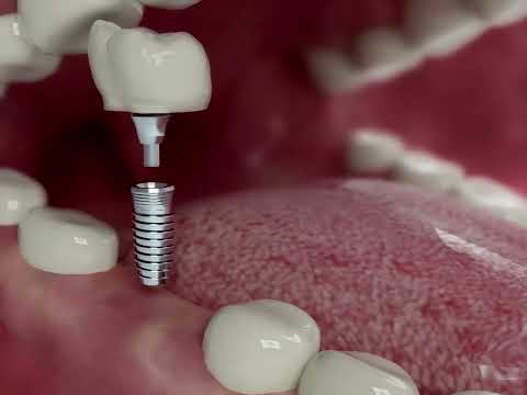 Video showing implant placement