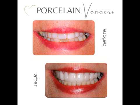 Smile Makeover with Porcelain Veneers - Before and After #cosmeticdental