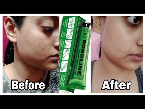 Boroline: How to get rid of razor bumps/rash/small pimple on face | Home remedy