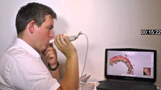 Insane speed-scanning with 3Shape TRIOS 3 intraoral scanner