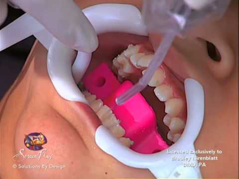 Getting Braces On: Nirenblatt Orthodontics