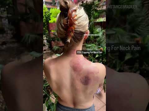 Got pain? You need cupping 🔥 🔮 💪
