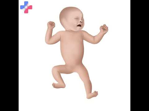 Time Lapse: Caudal Regression Syndrome