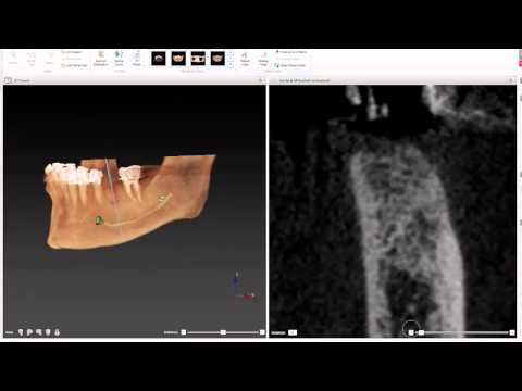 Digital Dental Implant Placement Using NobelClinician
