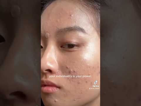 Skin transformation from Jan 2022- Jan 2024 | Acne journey #shorts #skincare #acne