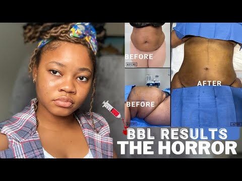 What doctors don’t tell about BBL