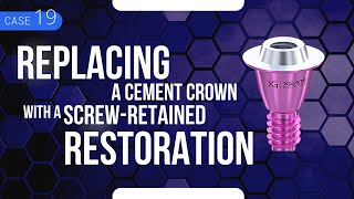Replacing a Cement Crown with a Screw-Retained Restoration. Aesthetic Aspects of the Crown