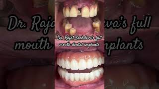 Get FULL MOUTH DENTAL IMPLANTS in India with the BEST DENTIST in Delhi!
