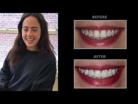 Get Wedding-Ready with Dr. Kosdon's Smile Makeover